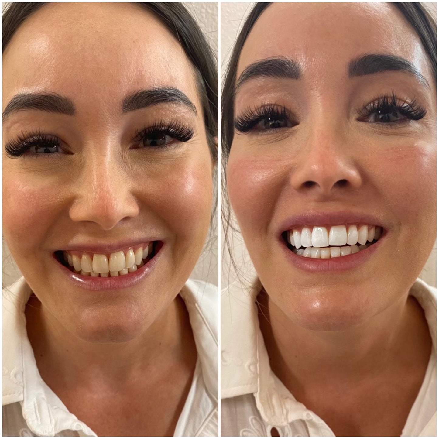 Teeth Whitening Kit