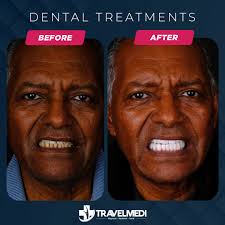 Teeth Whitening Kit